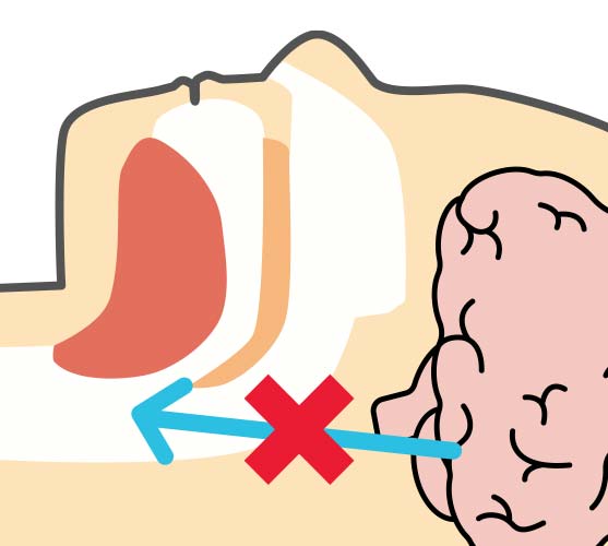 中枢性睡眠時無呼吸症候群(CSAS)