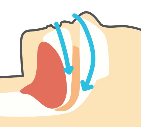 閉塞性睡眠時無呼吸症候群(OSAS)